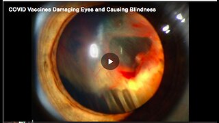 How the COVID-19 vaccines damage the eyes and cause blindness