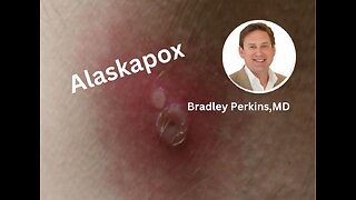 Alaskapox: What do we know about this virus?