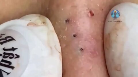 Removal / extraction of blackheads and pimples. Satisfying videos to relax!