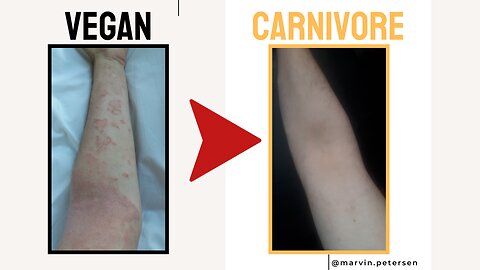 My Eczema Experience on the Vegan Diet (vs. Carnivore Diet)