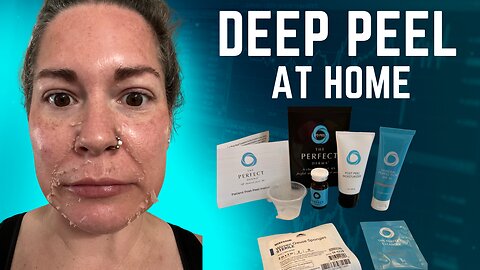 Deep peel at home | Perfect Derma Peel