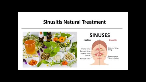 Sinusitis Natural Treatment Natural Treatment