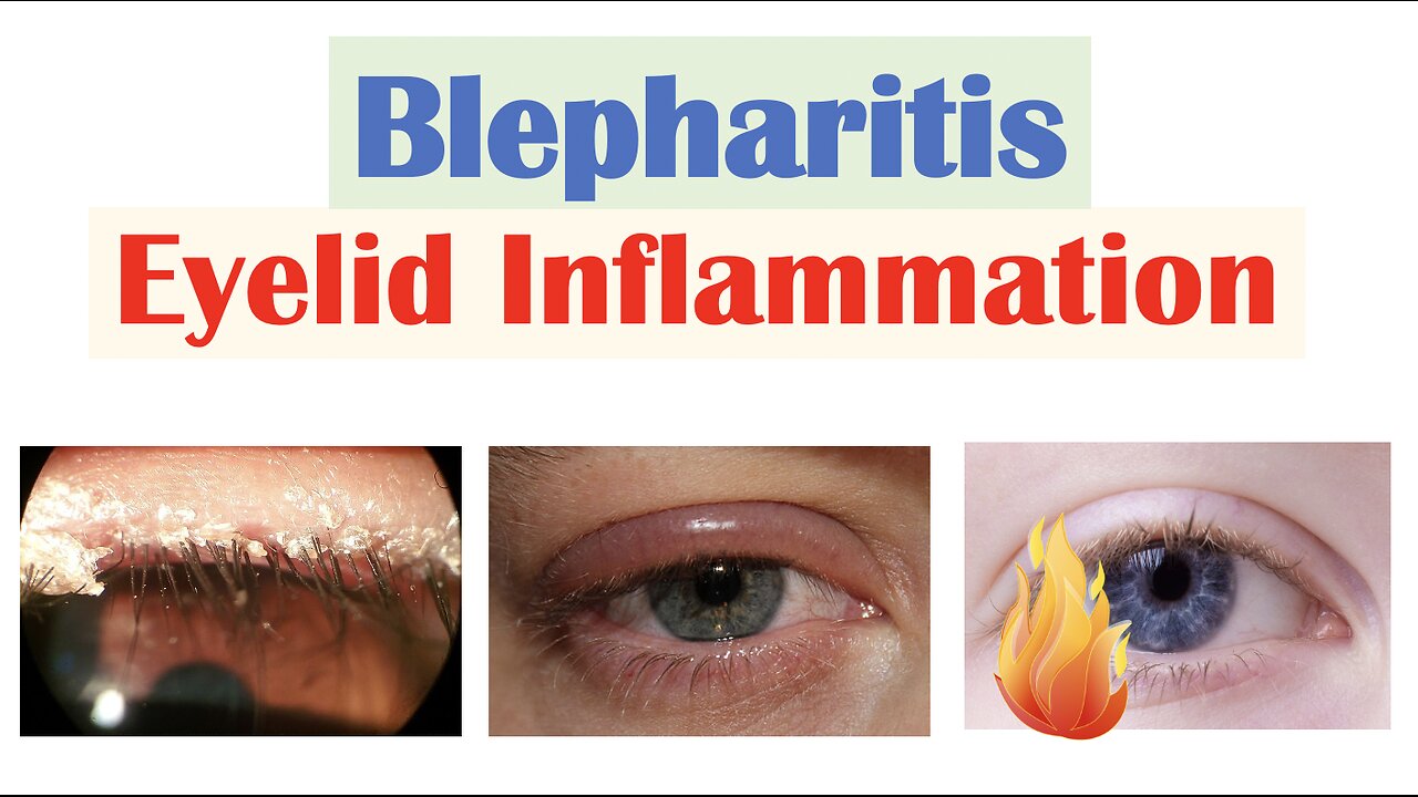 Blepharitis (Eyelid Inflammation) Causes, Risk Factors, Signs