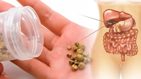How to Get Rid of Gallstones Naturally