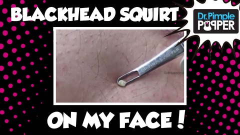 Back Blackheads Squirt onto my FACE!!