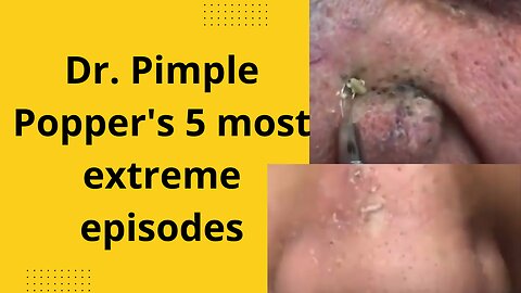 dr pimple popper blackhead extraction pops whiteheads whiteheads #pimple