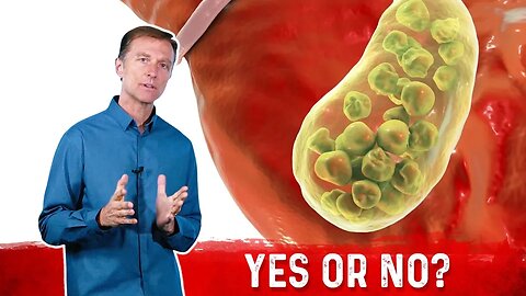 Do Gallstones Come From High Cholesterol? – Dr.Berg