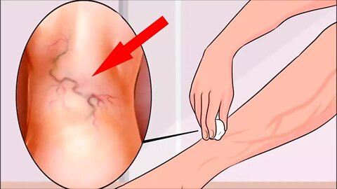 Get Relief from Varicose Veins With This Natural Treatment