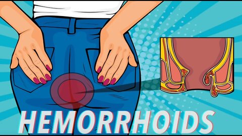 | How to Alleviate hemorrhoids |