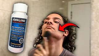 DEIXANDO A BARBA CRESCER COM MINOXIDIL