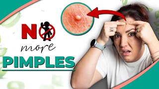 How to GET RID of PIMPLES || QUICK & EASY hacks