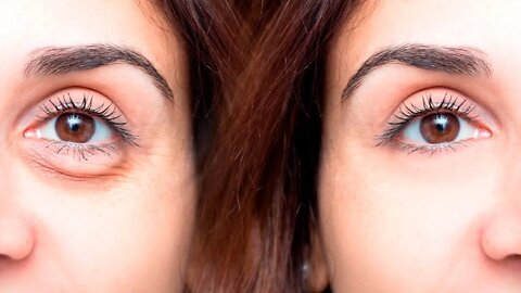 How To Get Rid of Dark Circles With 3 Unusual Home Remedies