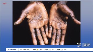 Health officials monitoring more cases of monkeypox, say some spread is likely