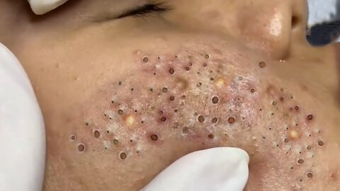 Blackheads - Blackhead Removal - Acne Extraction Relaxing #51