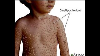 Dr Suzanne Humphries & Del Bigtree (Highwire) Smallpox 'Vaxx ingredients' & Polio (both still live diseases) & 'Sarracenia Purpurea' treatment