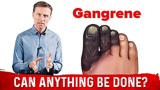 Diabetic Gangrene: Symptoms, Causes & Treatment – Dr.Berg On Diabetic Foot