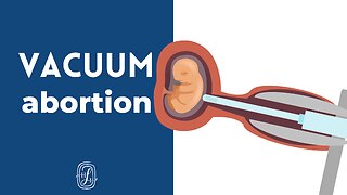 How Do Vacuum Abortions Work?