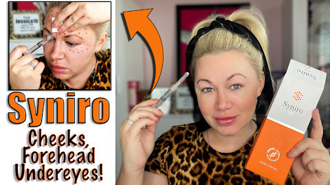 Syniro PDRN Meso Therapy in Cheeks Forehead and Undereyes | Code Jessica10 Saves you $$$$