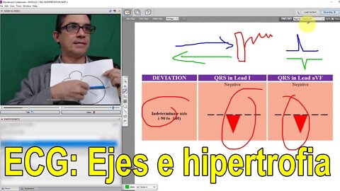 Lecciones de ECG: Eje e hipertrofias.