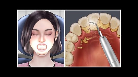 ASMR teeth scaling -tartar removal animation
