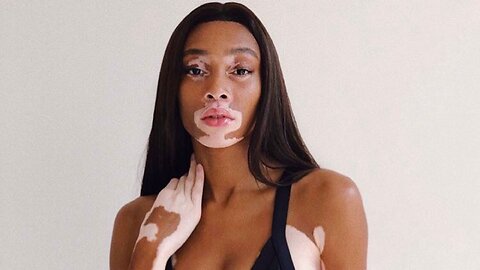 Winnie Harlow Calls Out Jess Hilarious For Allegedly Talking About Her Skin 👀