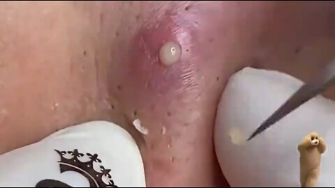 Very Satisfying Pimple Popping!