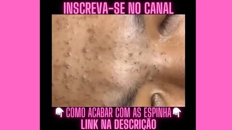 Que delicia de cravo nas costas Espremendo Espinhas e Cravos