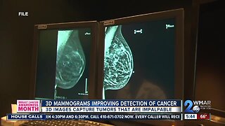 3D Mammogram detects local woman's stage 1 breast cancer