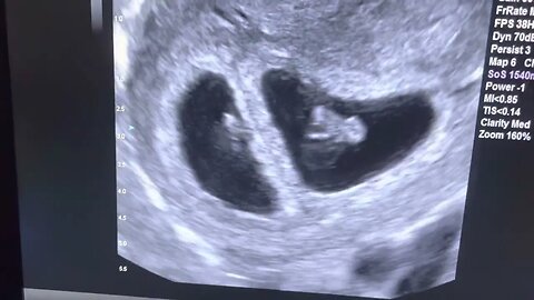 Sonogram: Twins at 7 weeks gestation!