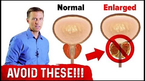 4 Things to Avoid if You Have an Enlarged Prostate – Dr.Berg