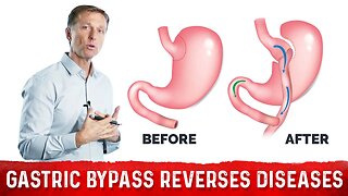Why Gastric Bypass Reverses Diabetes and Many Diseases