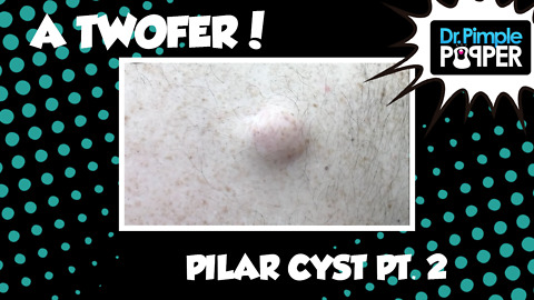 A Twofer: Part Two - Two Types of Cysts