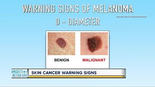 Can you spot skin cancer? Keep an eye out for these warning signs