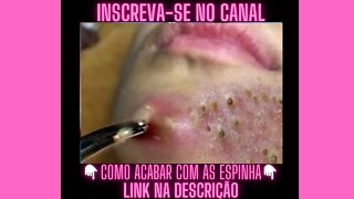 Estourando espinhas inflamadas Espremendo Espinhas e Cravos