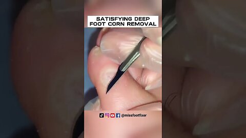 SATISFYING DEEP FOOT CORN REMOVAL BY MISS FOOT FIXER
