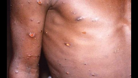 Officials Buying Monkeypox Vaccines Following First US Infection
