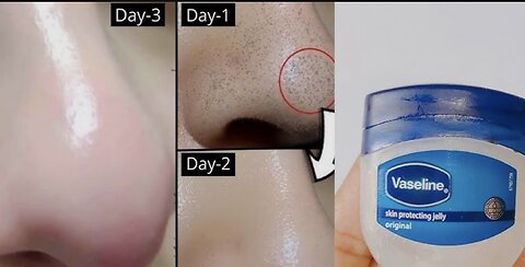 How to remove blackheads and White heads 😵from nose and face naturally at home