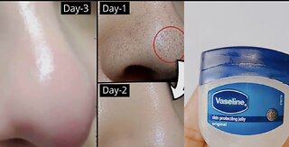 How to remove blackheads and White heads 😵from nose and face naturally at home