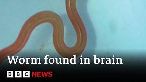 Live worm found in Australian woman's brain - BBZNews