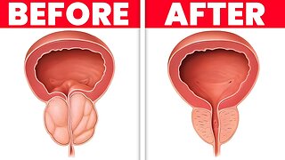 Drink 1 CUP PER DAY to Shrink an Enlarged Prostate