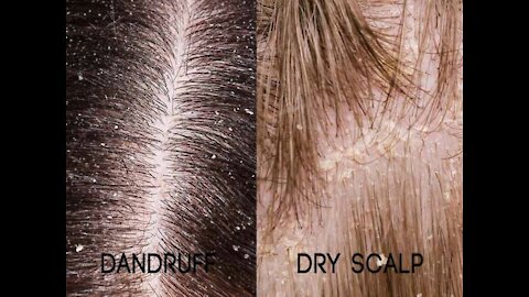 How to cure dry scalp dandruff