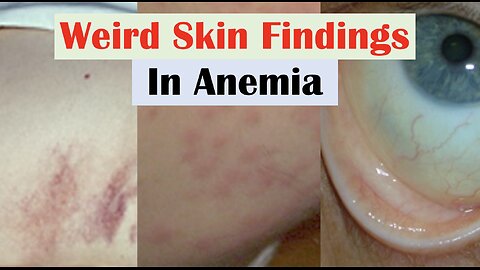 Anemia and Skin Findings (along with Nail Changes and Mouth Sores)