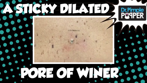 Dr Pimple Popper: A Sticky Dilated Pore of Winer