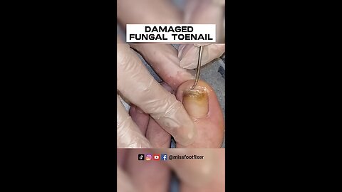 DAMAGED FUNGAL TOENAIL [ Discoloration of the Nail ] FULL TREATMENT BY MISS FOOT FIXER