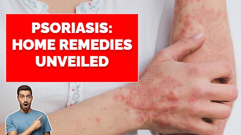 Psoriasis Home Remedies Unveiled 2023