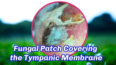 Fungal Patch Covering the Tympanic Membrane