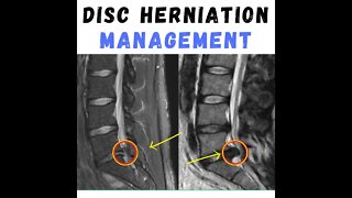 Does lumbar disc bulges heal ?