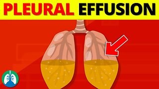 Pleural Effusion (Medical Definition) | Quick Explainer Video