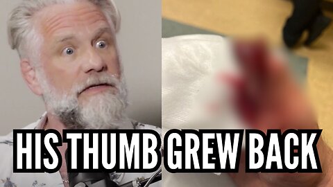 Thumb Grows Back After Stem Cell Treatment in Mexico! (WARNING: Graphic Photo)