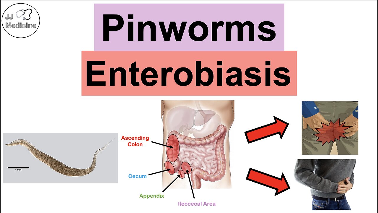 Pinworms (Enterobiasis) | Infection, Transmission, Symptoms, Diagnosis ...